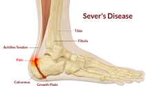 sever's disease - dunsborough physiotherapy info